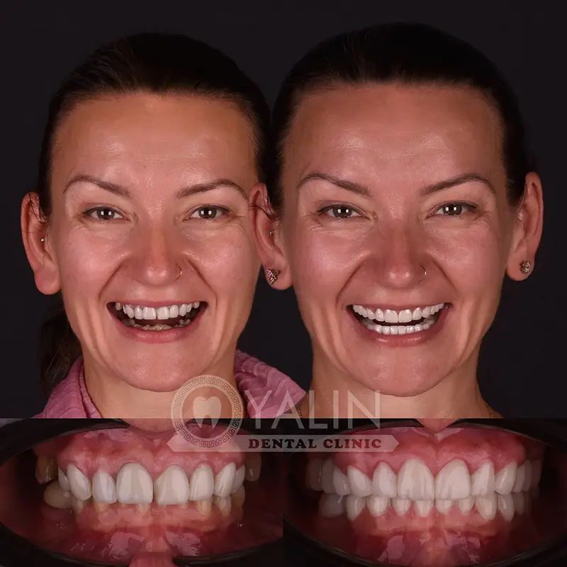 emax veneers in Turkey
