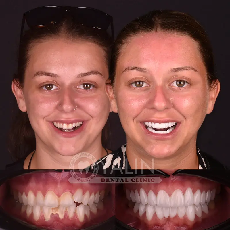 emax veneers in Turkey