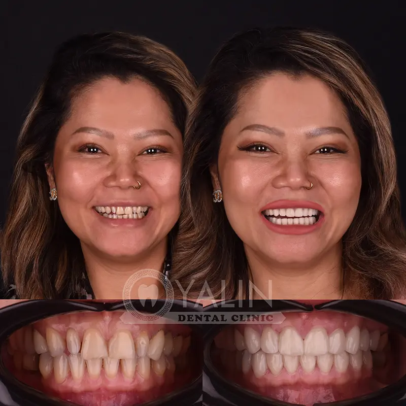 emax veneers in Turkey
