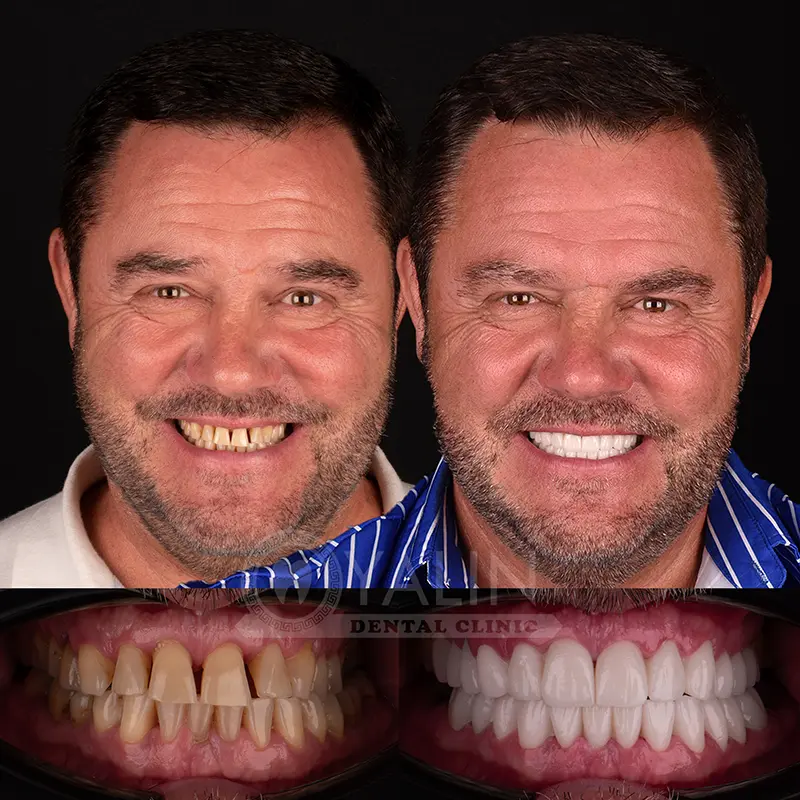 emax veneers in Turkey