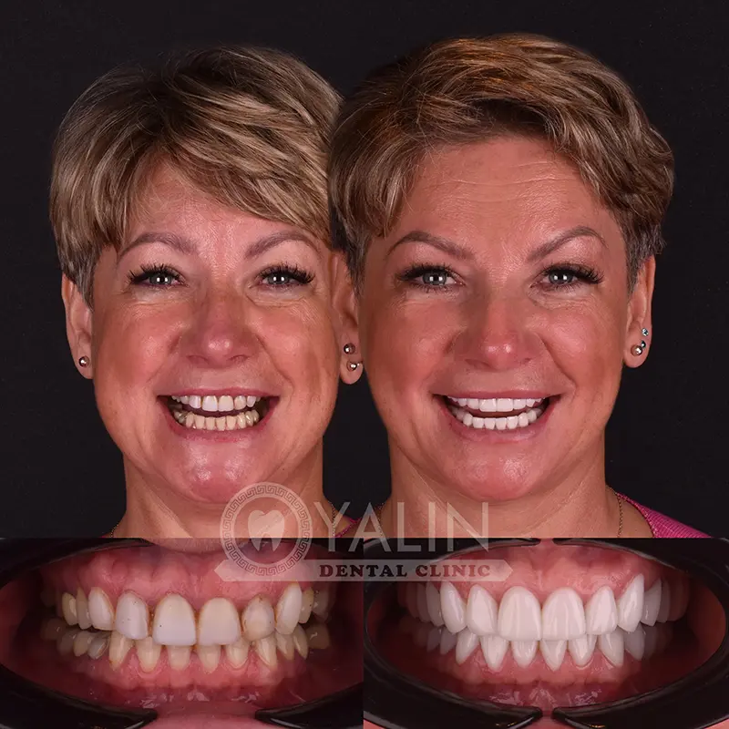emax veneers in Turkey