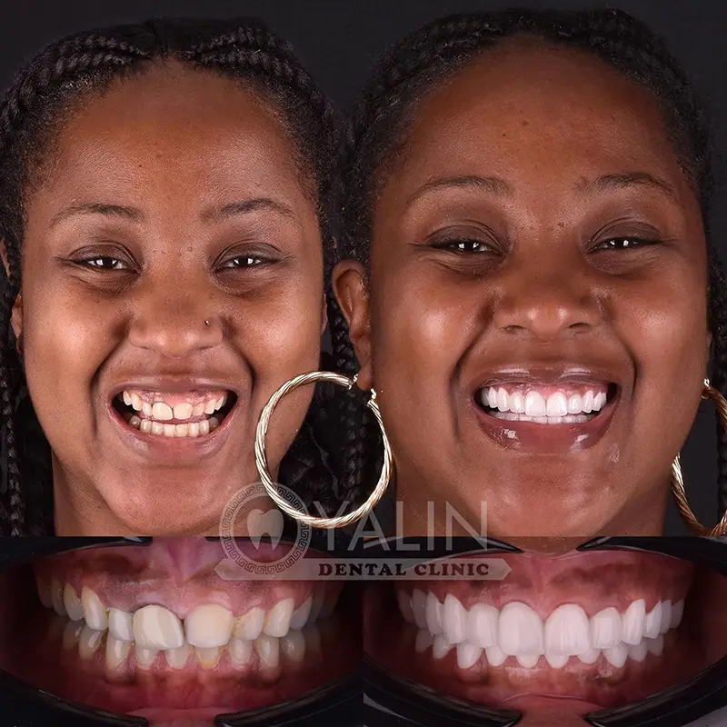 Laser Gum Treatment for Periodontal Disease