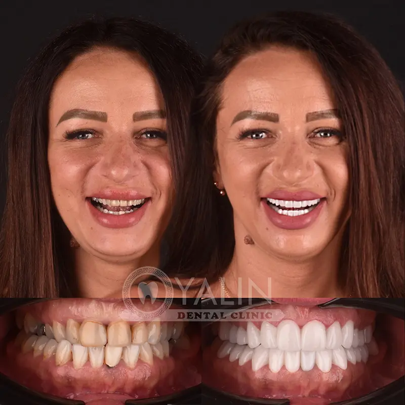 Laser Gum Treatment for Periodontal Disease