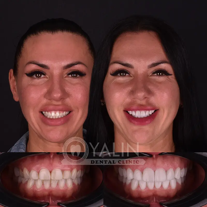 Laser Gum Treatment for Periodontal Disease