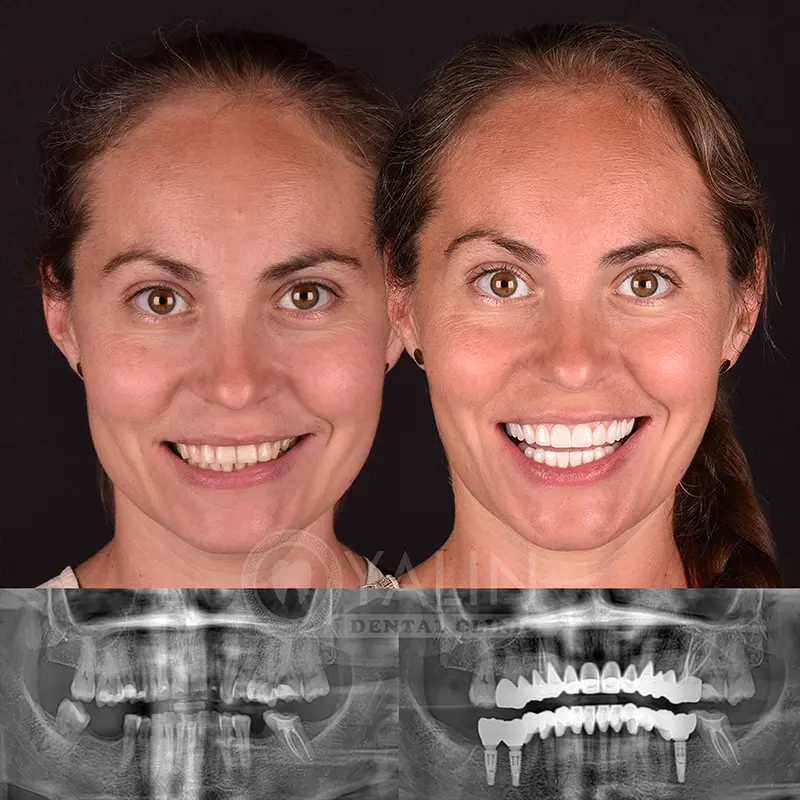 Yalındental Clinic, dental implant - dental cron