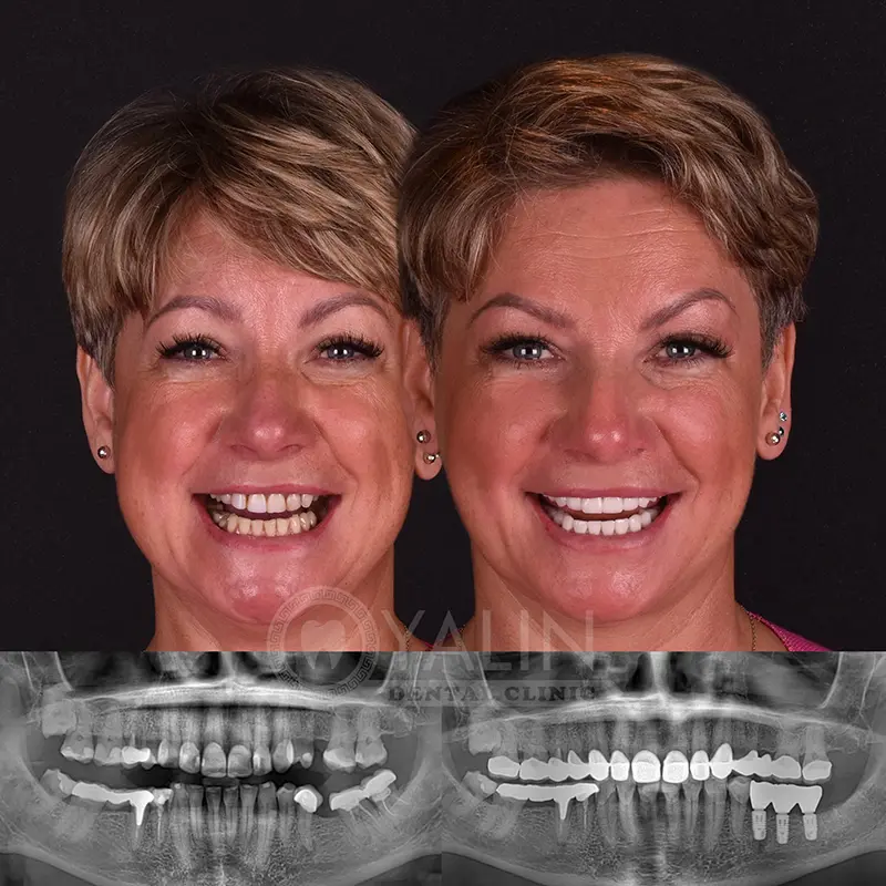 Yalındental Clinic, dental implant - dental cron