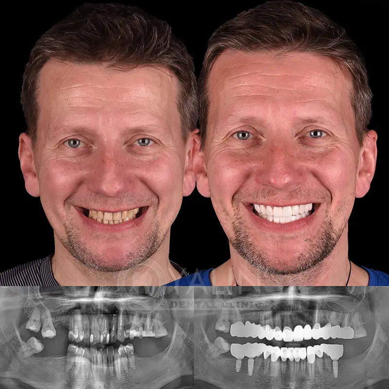 Yalındental Clinic, dental implant - dental cron