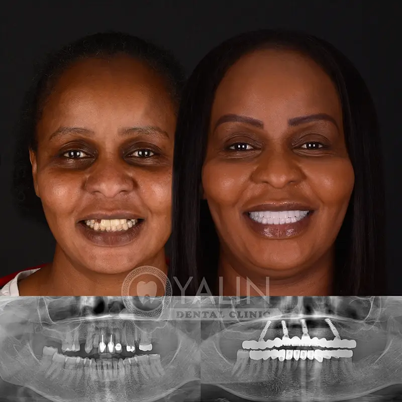 Yalındental Clinic, dental implant - dental cron