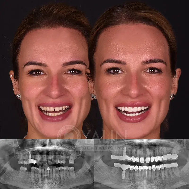 Yalındental Clinic, dental implant - dental cron