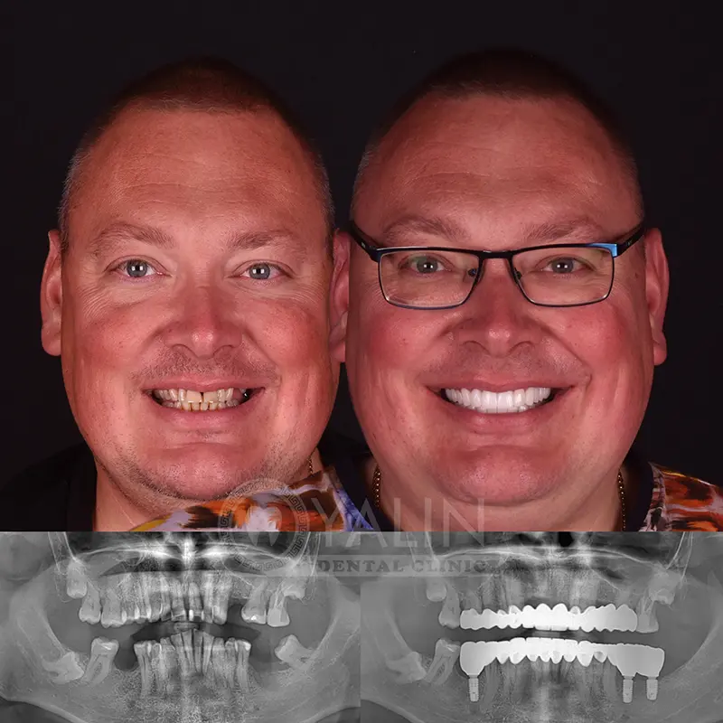 Yalındental Clinic, dental implant - dental cron