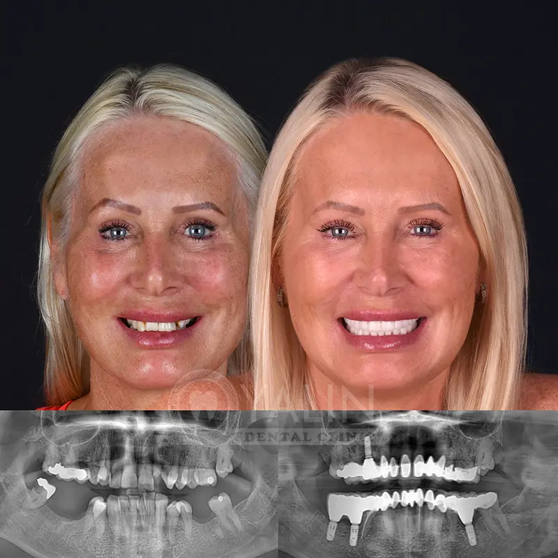 Yalındental Clinic, dental implant - dental cron