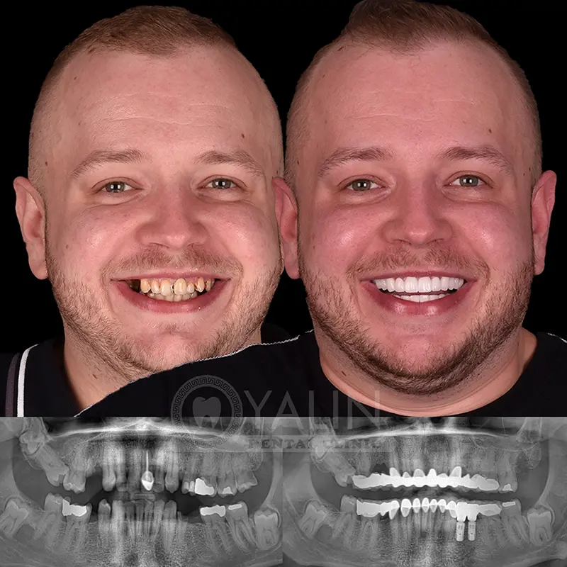 Yalındental Clinic, dental implant - dental cron