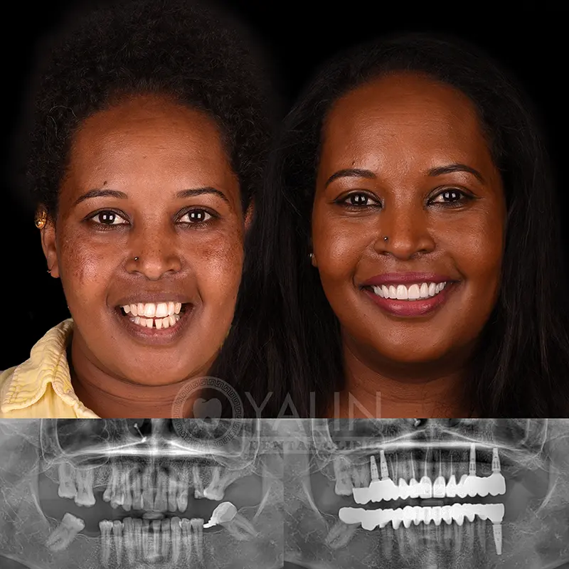 Yalındental Clinic, dental implant - dental cron