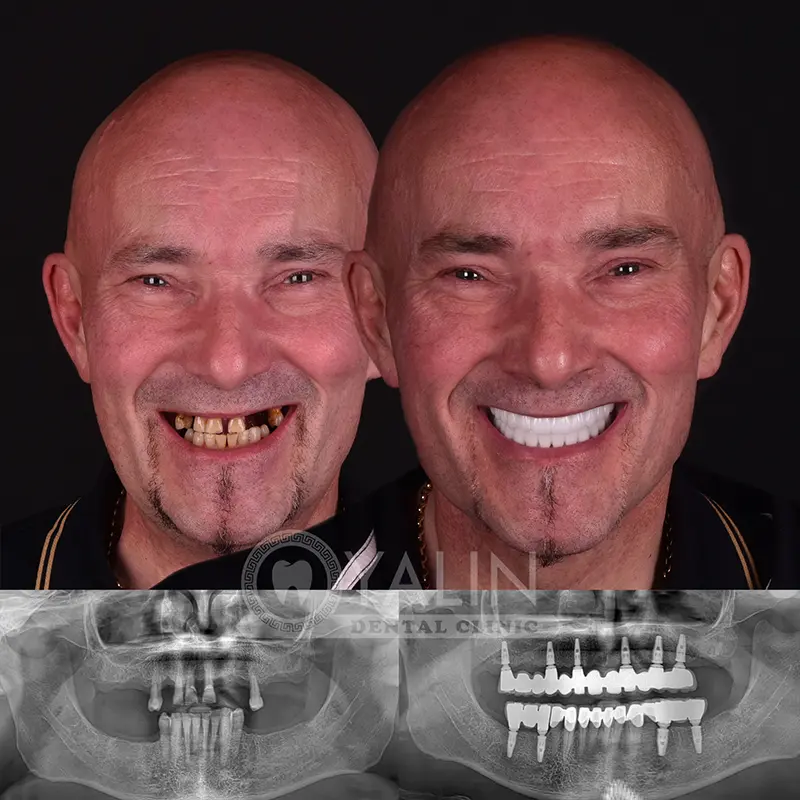 Yalındental Clinic, dental implant - dental cron