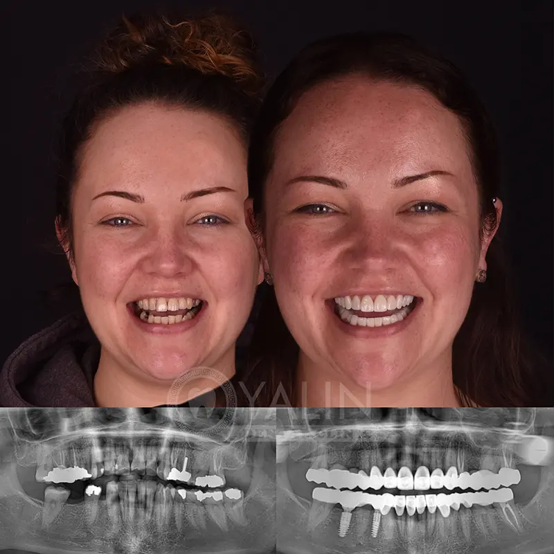 Yalındental Clinic, dental implant - dental cron