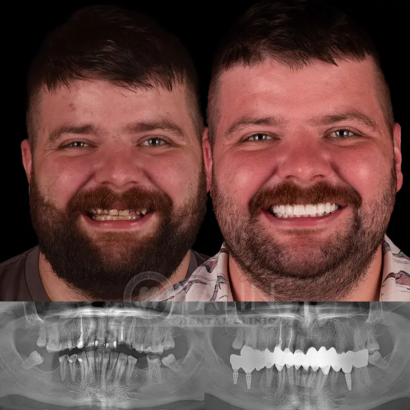 Yalındental Clinic, dental implant - dental cron