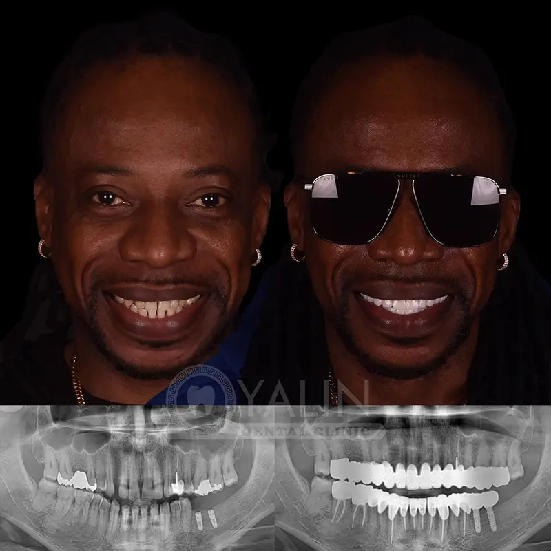 Yalındental Clinic, dental implant - dental cron