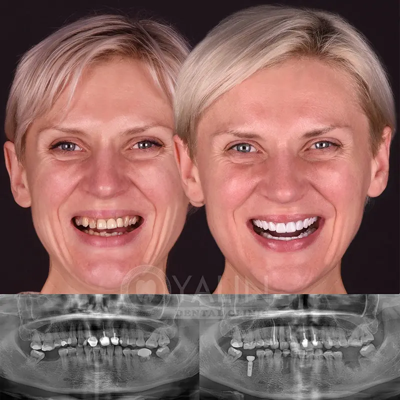 Yalındental Clinic, dental implant - dental cron