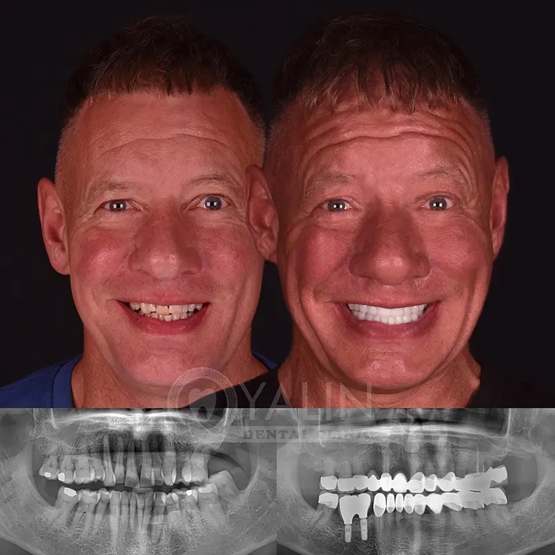 Yalındental Clinic, dental implant - dental cron