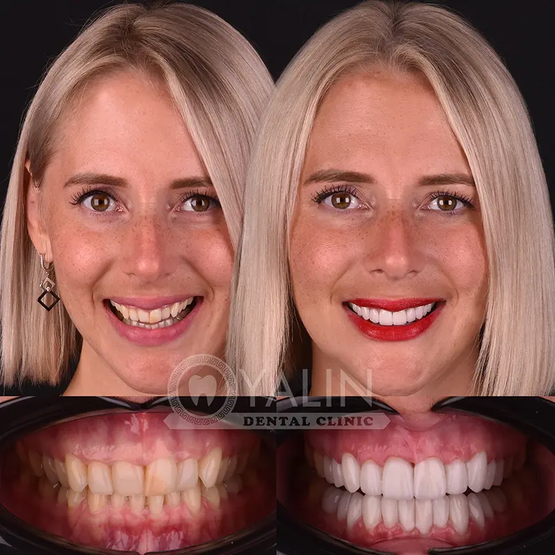 laminate veneers in Turkey