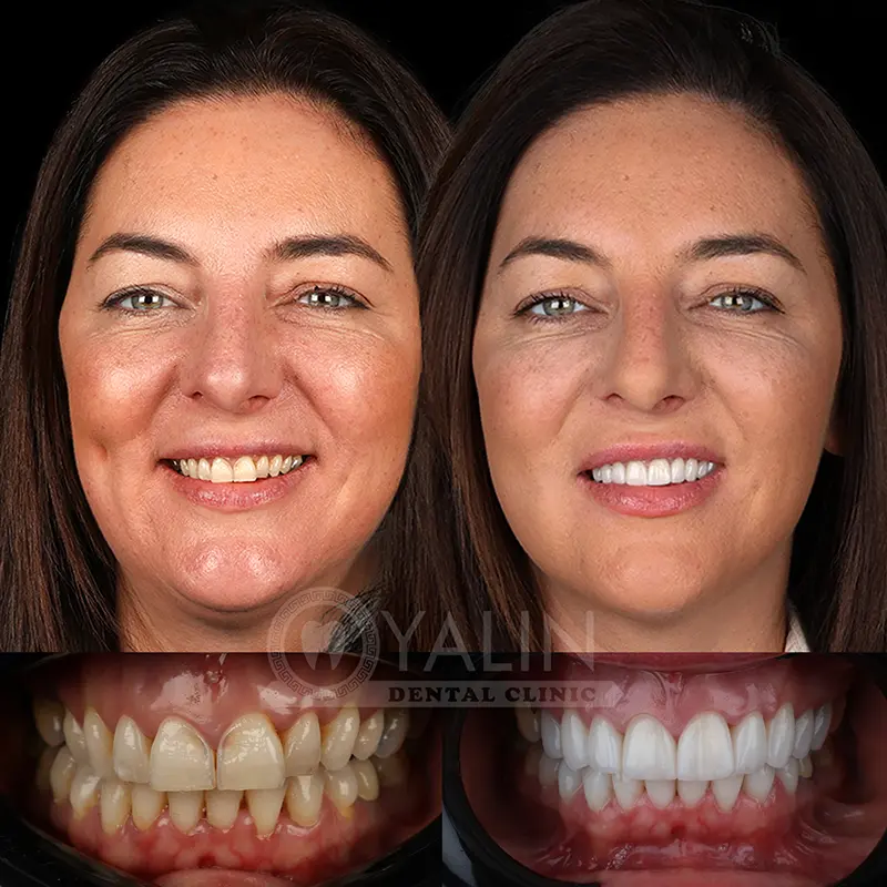 laminate veneers in Turkey