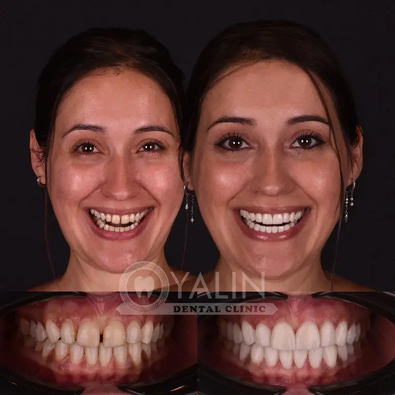 laminate veneers in Turkey