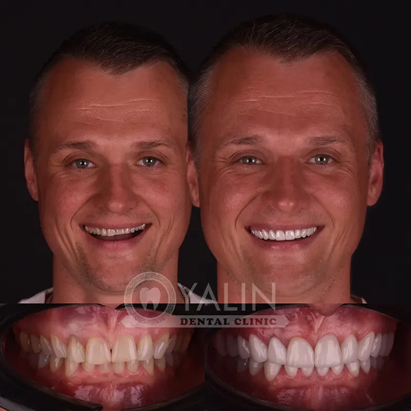 laminate veneers in Turkey