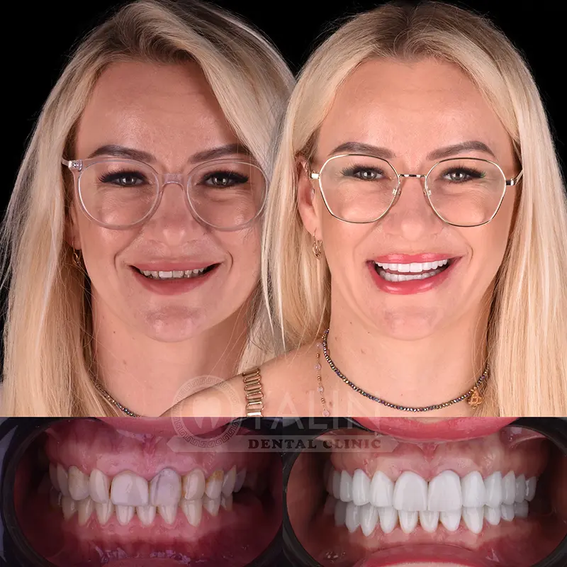 laminate veneers in Turkey