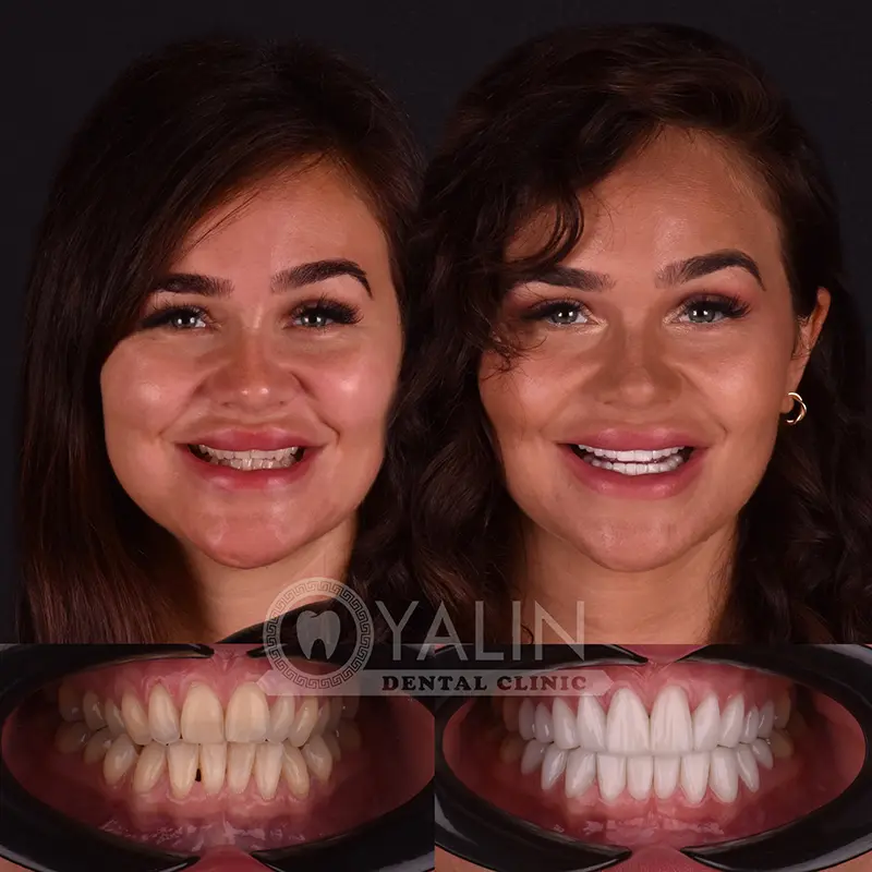 laminate veneers in Turkey