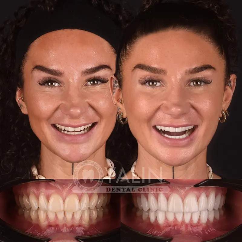 laminate veneers in Turkey