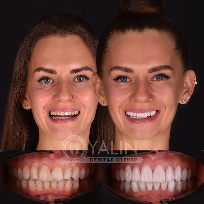 laminate veneers in Turkey