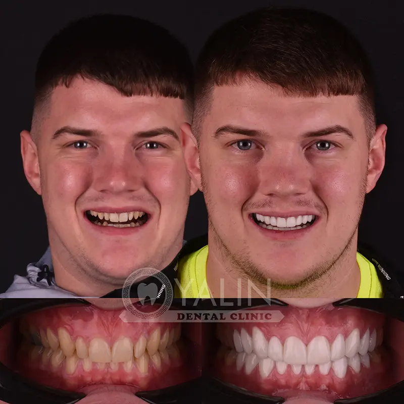 laminate veneers in Turkey