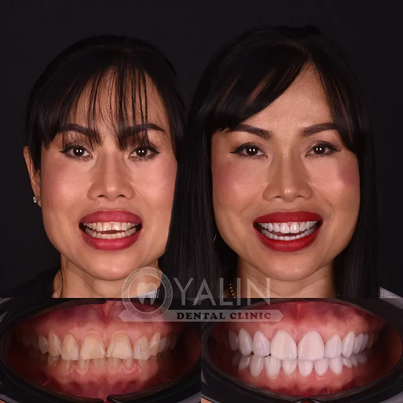 laminate veneers in Turkey