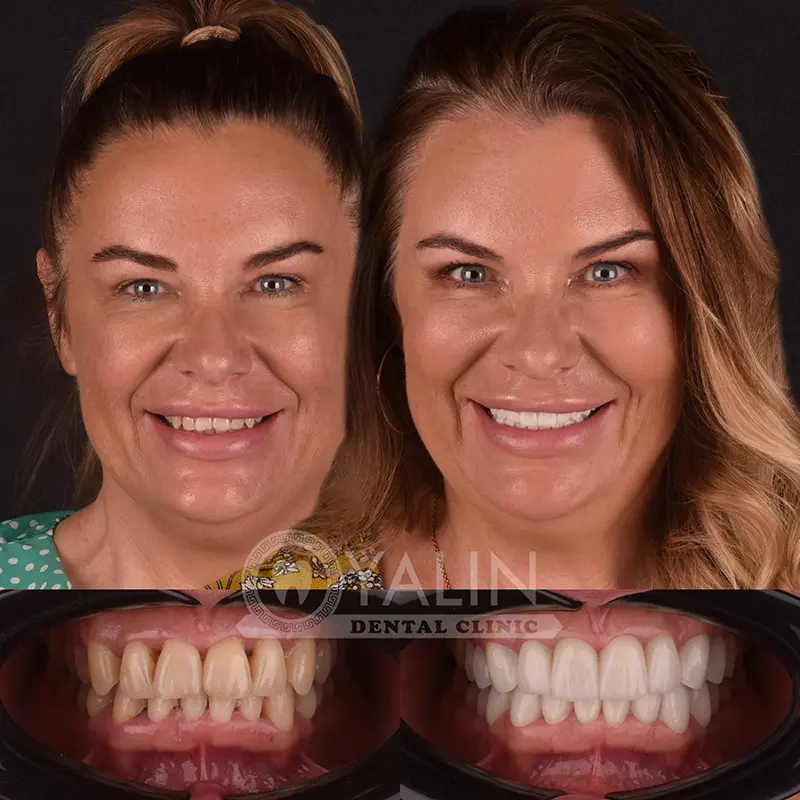 laminate veneers in Turkey