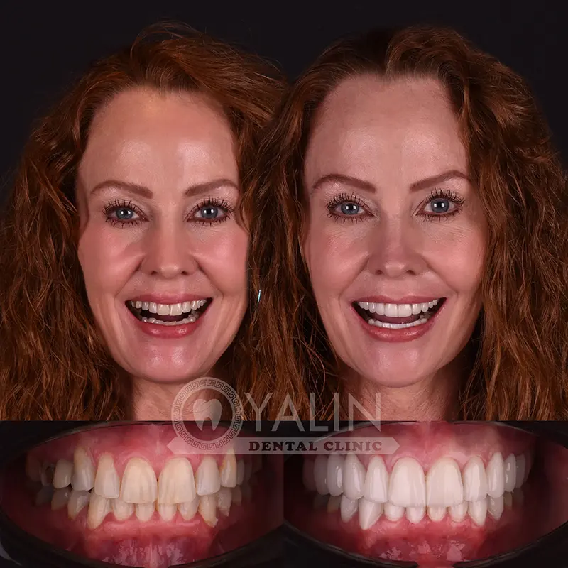laminate veneers in Turkey