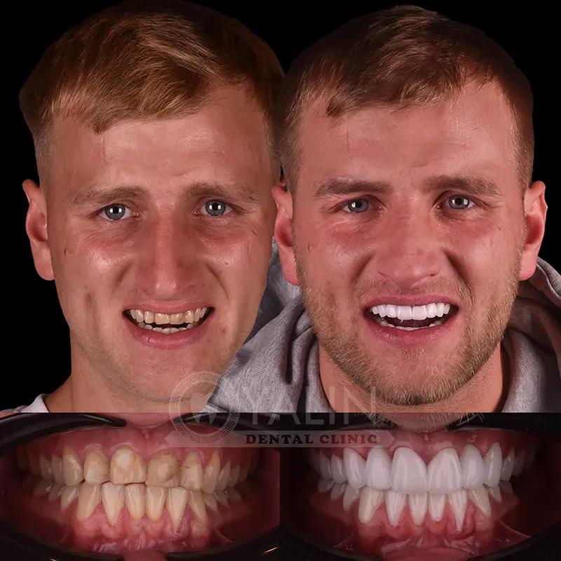 laminate veneers in Turkey