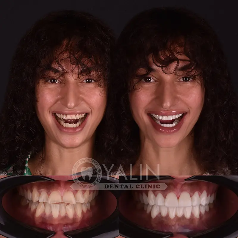 Yalındental Clinic, Zirconium crown