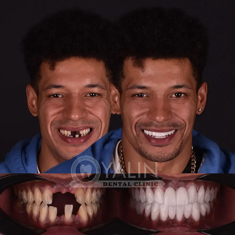 Yalındental Clinic, Zirconium crown