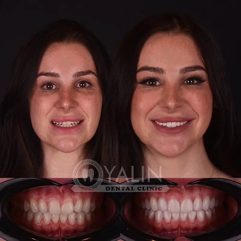Yalındental Clinic, Zirconium crown