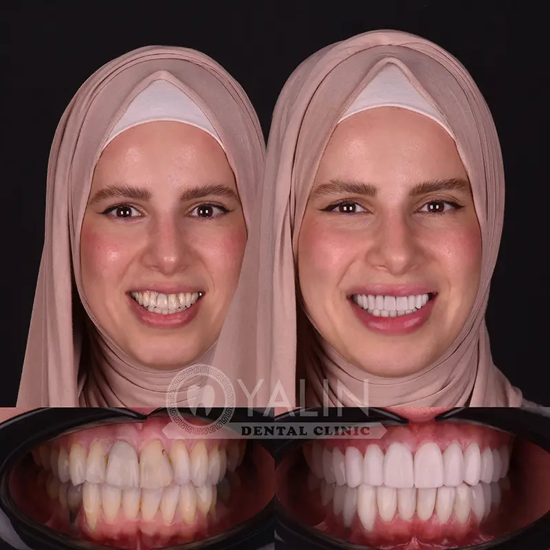 Yalındental Clinic, Zirconium crown