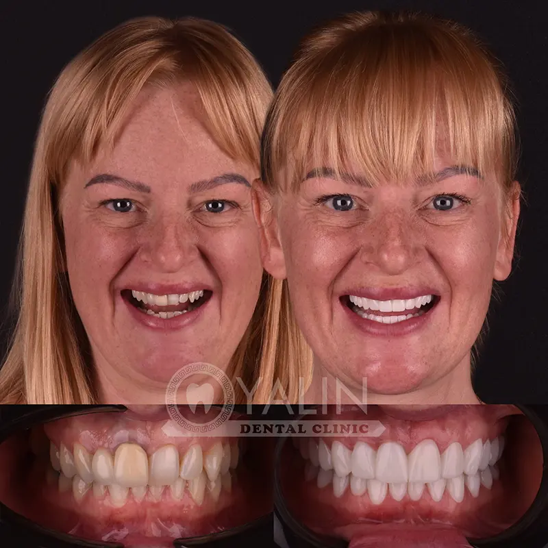 Yalındental Clinic, Zirconium crown