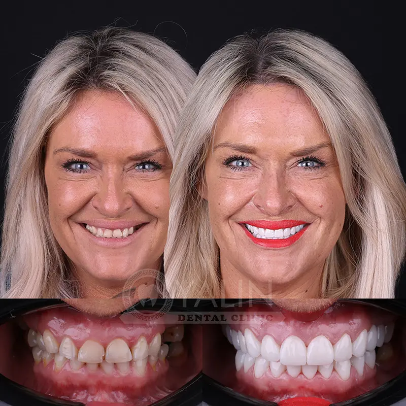 Yalındental Clinic, Zirconium crown