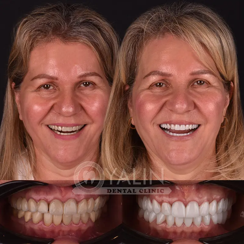 Yalındental Clinic, Zirconium crown
