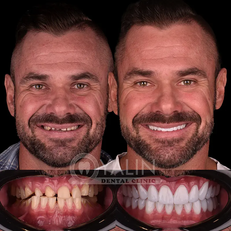 Yalındental Clinic, Zirconium crown