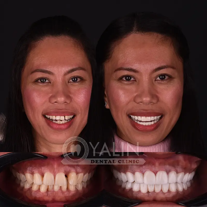 Yalındental Clinic, Zirconium crown