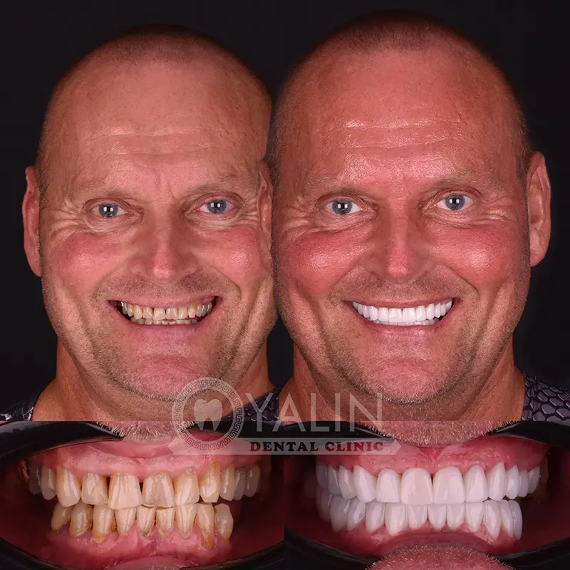 Yalındental Clinic, Zirconium crown