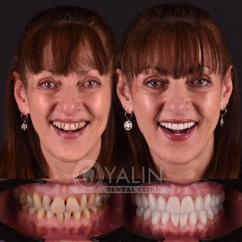 Yalındental Clinic, Zirconium crown