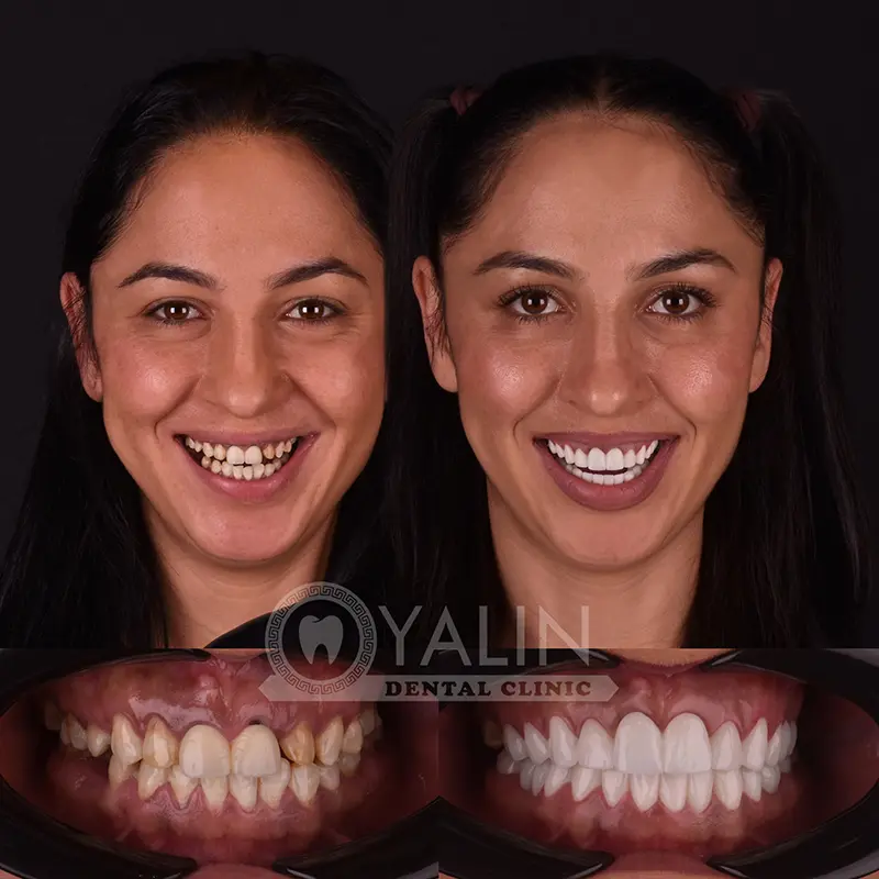 Yalındental Clinic, Zirconium crown