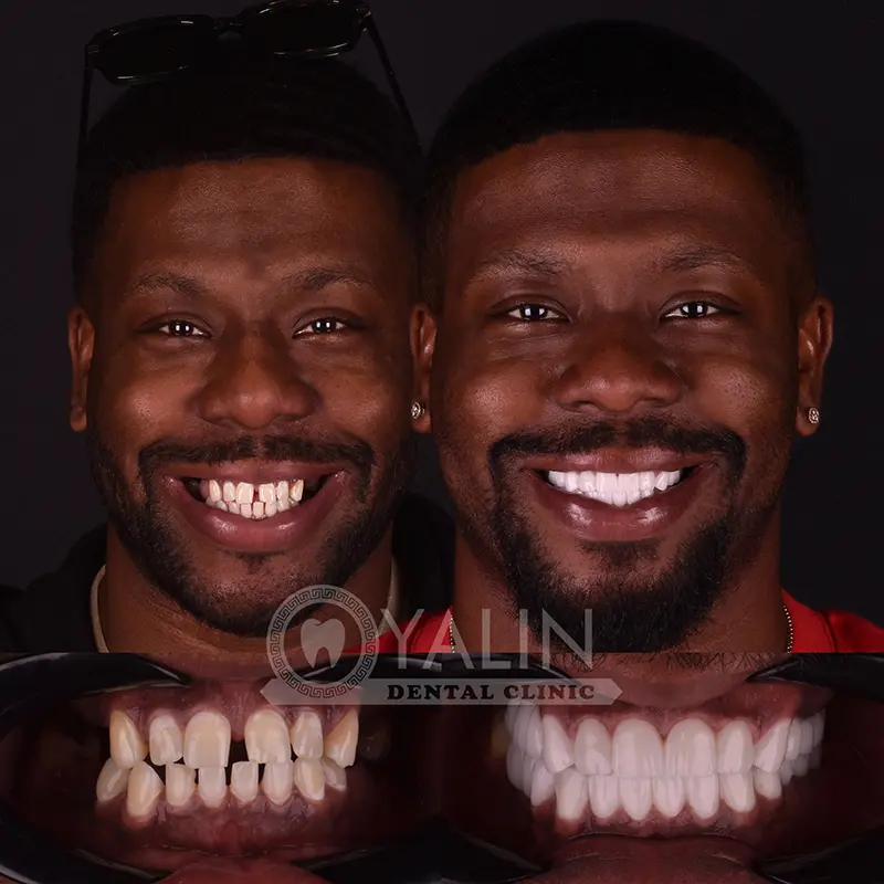 Yalındental Clinic, Zirconium crown