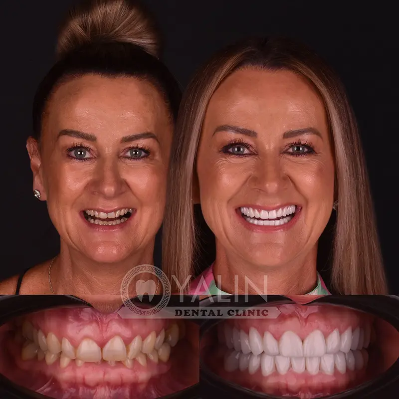Yalındental Clinic, Zirconium crown